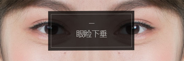 안검하수